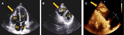 Myocarditis complicated by massive right ventricular thrombus and extensive pulmonary embolism: A case report